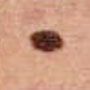 Asymetrisches Muttermal