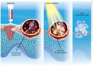 Photodynamische Therapie (PDT) mit Tageslicht bei JUVENIS in Wien