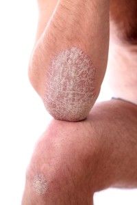 Schuppenflechte - Psoriasis Behandlung bei JUVENIS in Wien
