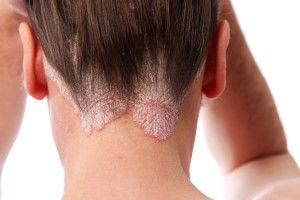 Schuppenflechte - Psoriasis Behandlung bei JUVENIS in Wien