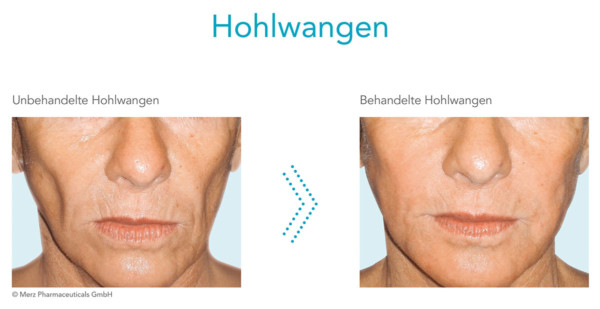 Radiesse® Faltenunterspritzung in Wien · JUVENIS