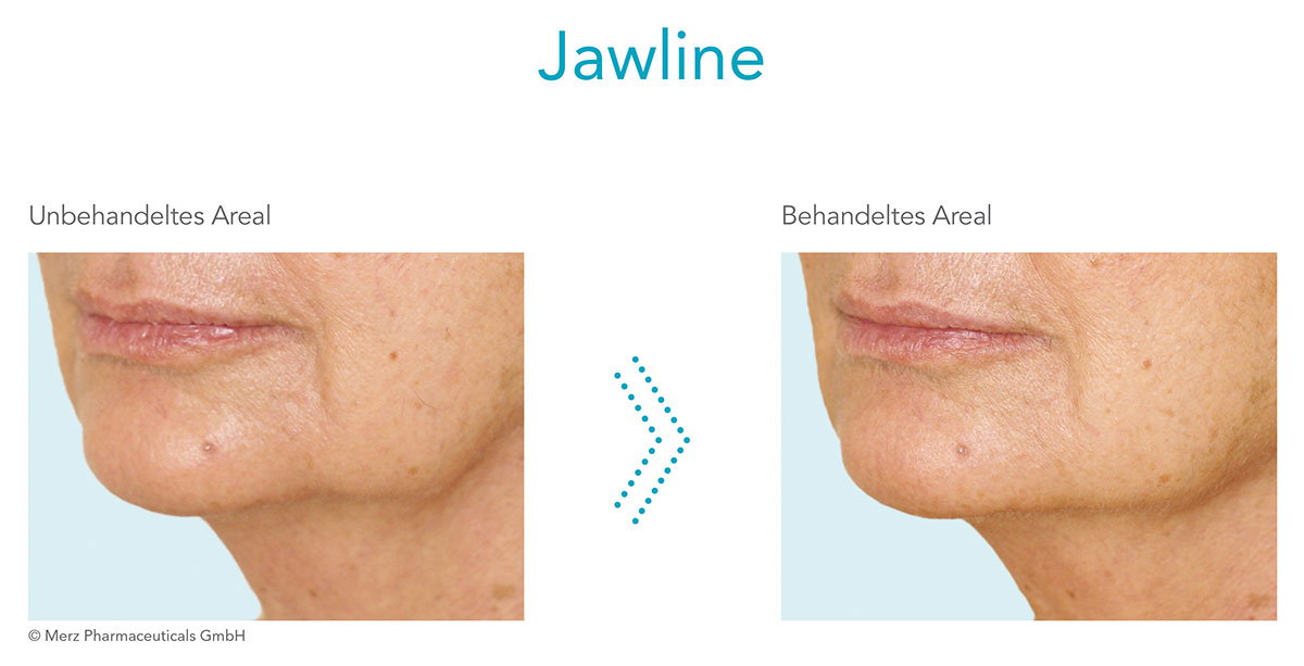 Vorher-Nachher-Bilder von Radiesse® Behandlung Jawline