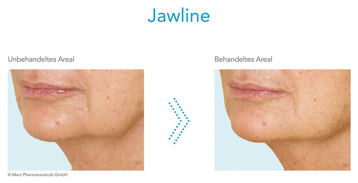 Radiesse® Faltenunterspritzung in Wien · JUVENIS