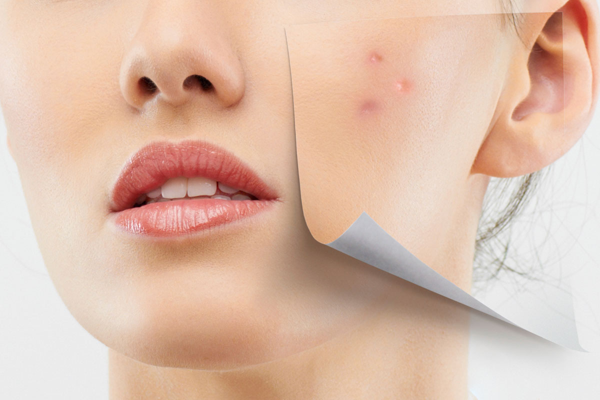 Rosazea, Akne Rosacea oder Röschenakne