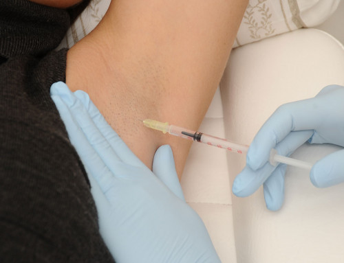 Botox for sweating: Effective treatment for excessive sweating