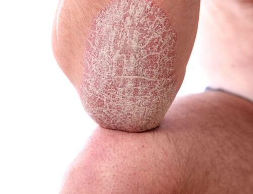 Welt-Psoriasistag am 29. Oktober – Bewusstsein schaffen