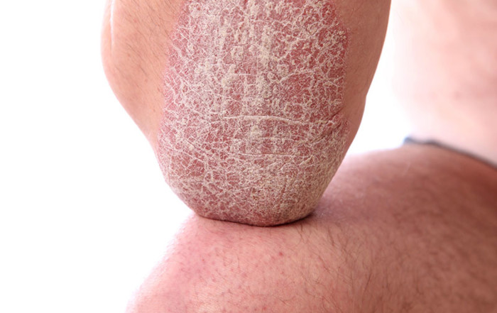 Schuppenflechte (Psoriasis) an Ellbogen und Knie