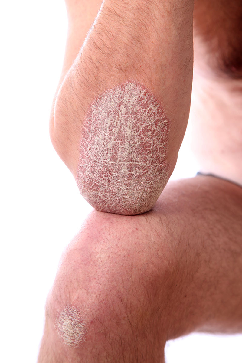 Schuppenflechte (Psoriasis) an Ellbogen und Knie