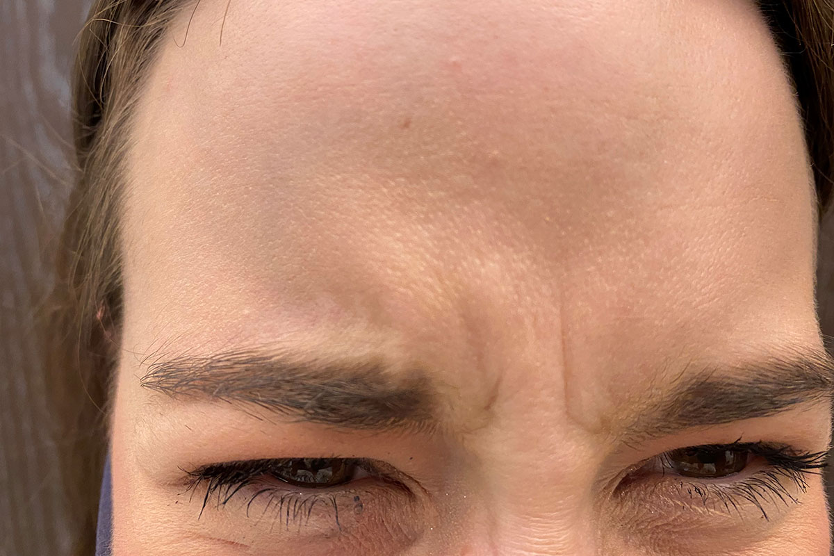 Zornesfalte vor Botox Behandlung bei JUVENIS