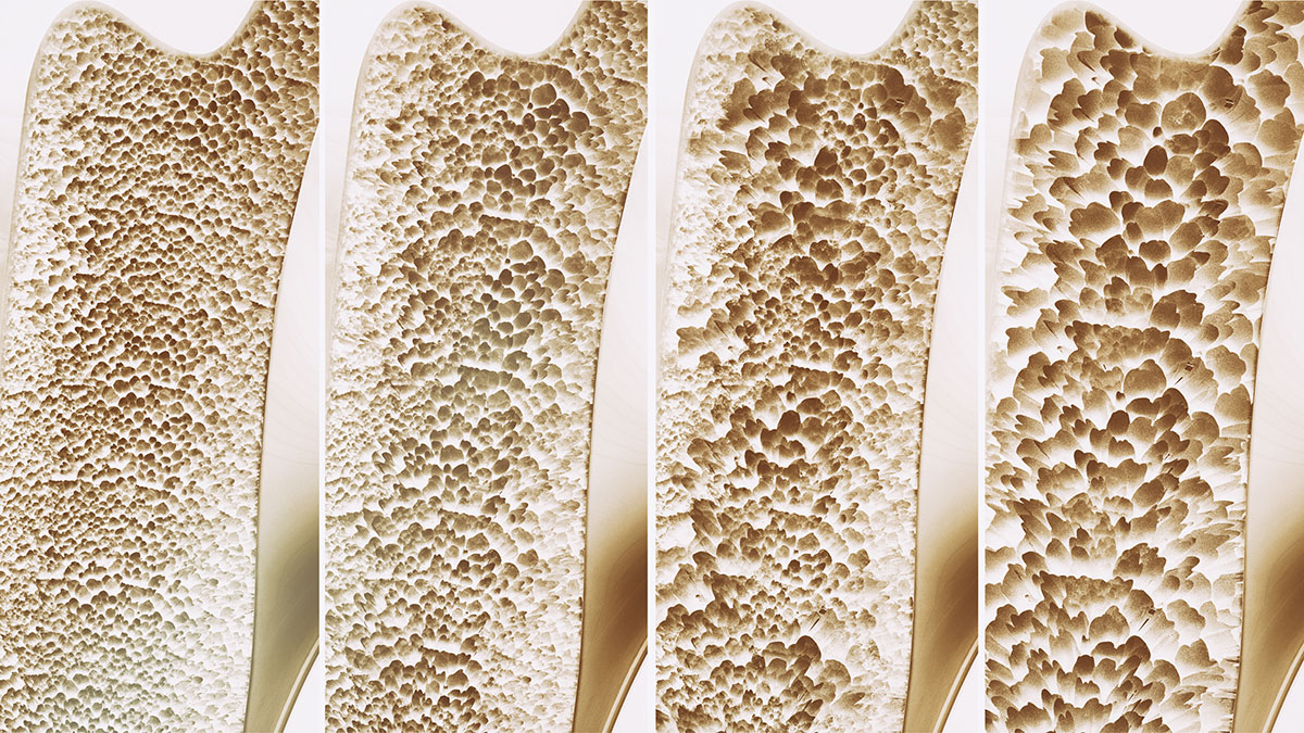 Darstellung Osteoporose