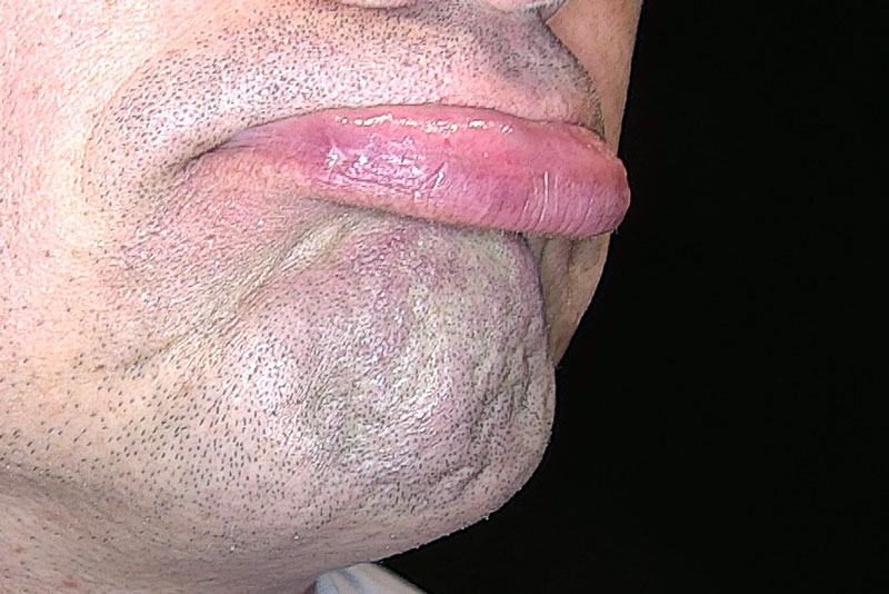 Nachher-Foto der Behandlung eines Hämangioms an der Lippe eines Mannes bei Juvenismed in Wien