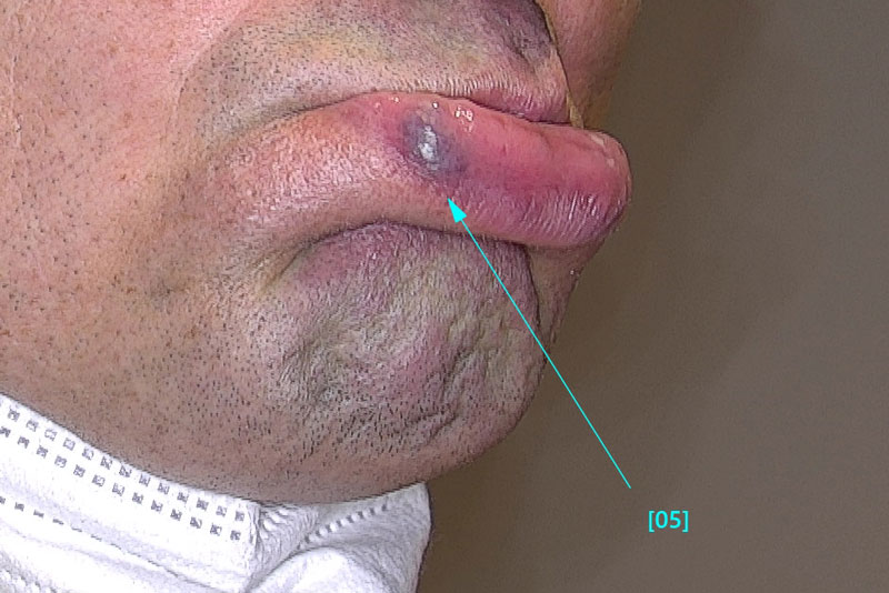 Vorher-Foto der Behandlung eines Hämangioms an der Lippe eines Mannes bei Juvenismed in Wien