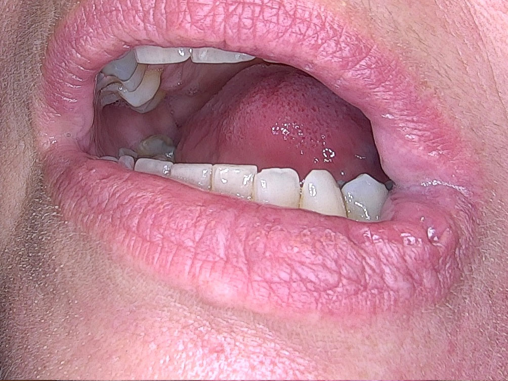Nachher Foto eines Hämangioms an der Lippe nach der Behandlung bei Juvenismed Wien