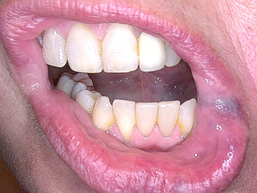 Vorher Foto eines Hämangioms an der Lippe