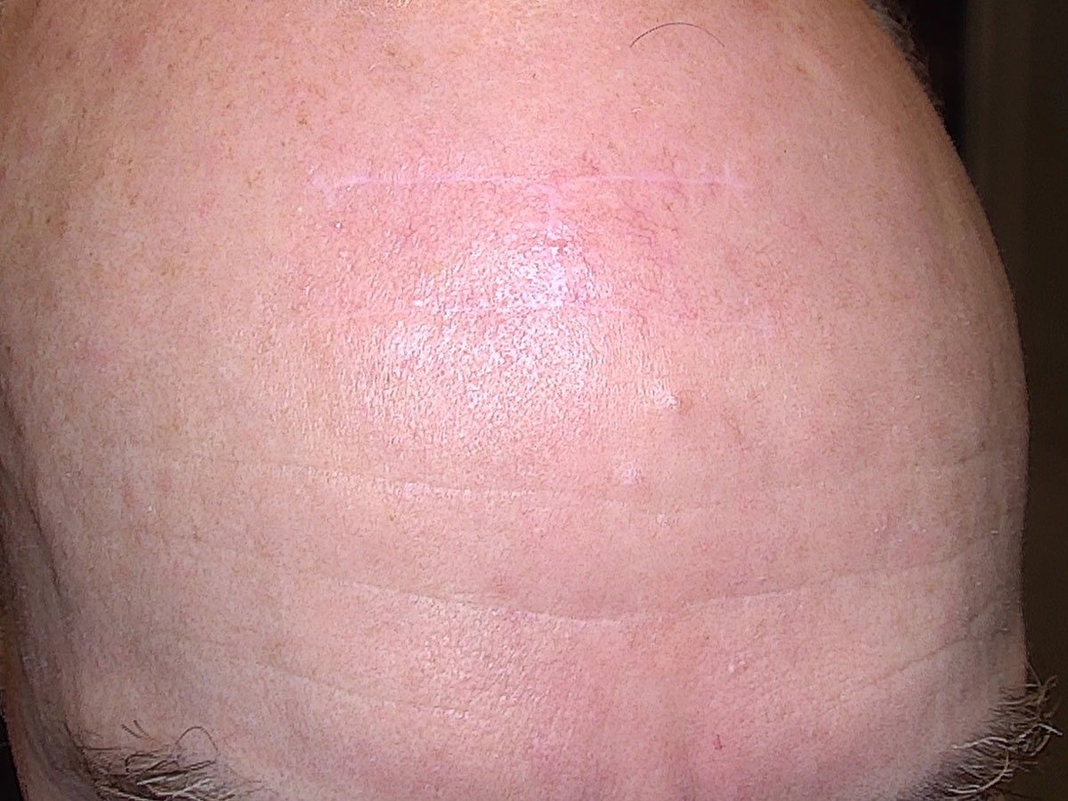 Nachher Foto der Exzision eines Plattenepithelkarzinoms (Dr. Kristen-Eichhorn) am Kopf eines Mannes. Hautkrebsbehandlung Juvenismed Wien