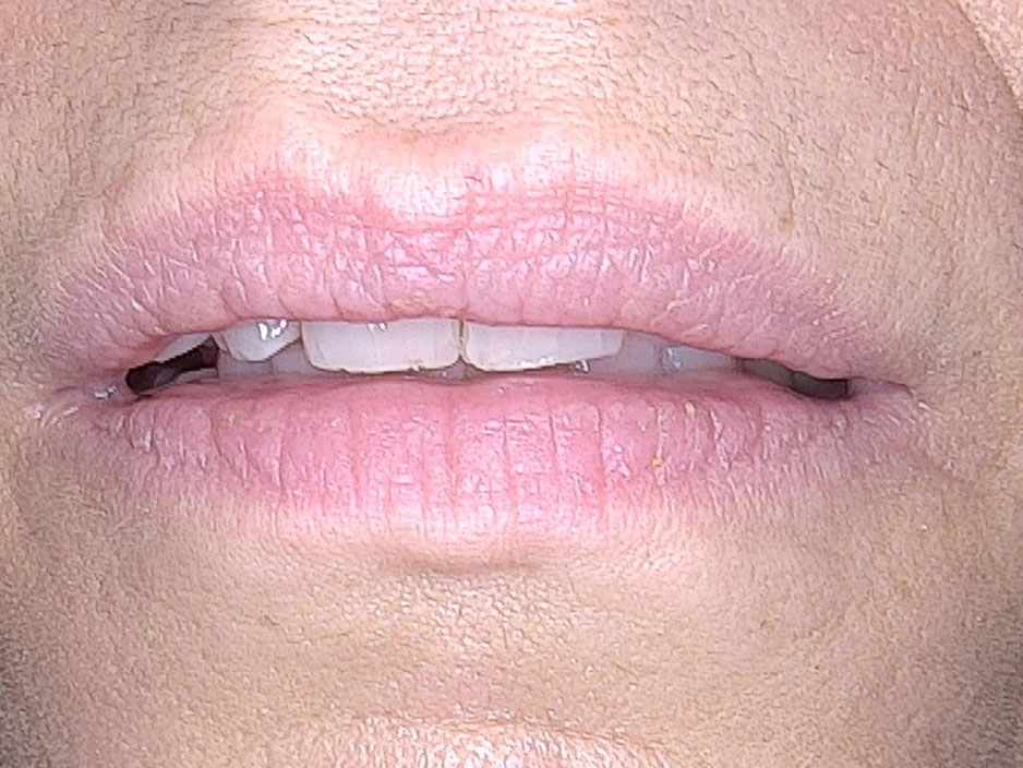 Vorher Foto eines Lippenangioms