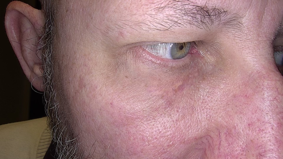 Nachher Foto eines Hämangioms an der Lippe nach der Behandlung bei JUVENISMED Wien