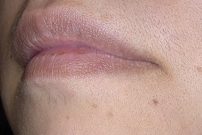 Nachher Foto eines Hämangioms an der Lippe nach der Behandlung bei Juvenis Wien