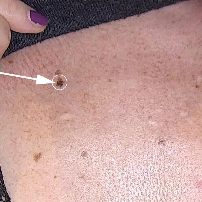 Melanom im Rahmen der Muttermalkontrolle frühzeitig erkannt bei JUVENIS in Wien von Dr. Tamara Kopp
