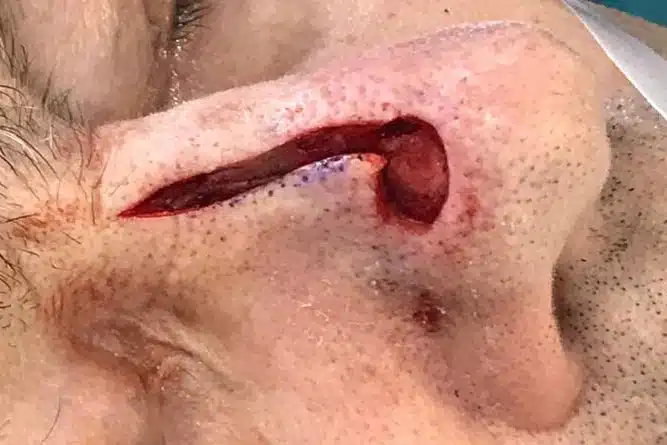 Dermatochirurgie: Basaliom Entfernung mit Verschiebe-Lappen-Plastik - JUVENIS in Wien