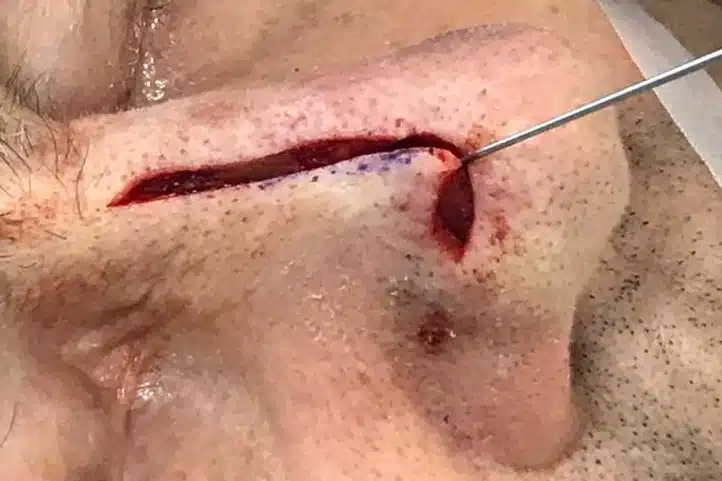 Dermatochirurgie: Basaliom Entfernung mit Verschiebe-Lappen-Plastik - JUVENIS in Wien