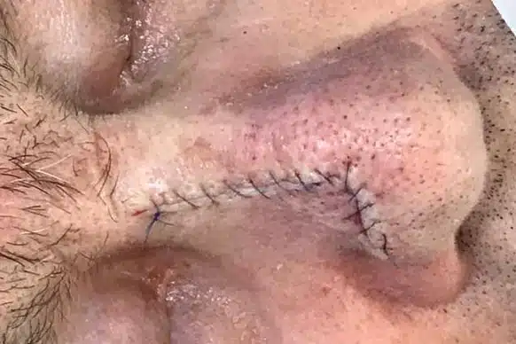 Dermatochirurgie: Basaliom Entfernung mit Verschiebe-Lappen-Plastik - JUVENIS in Wien
