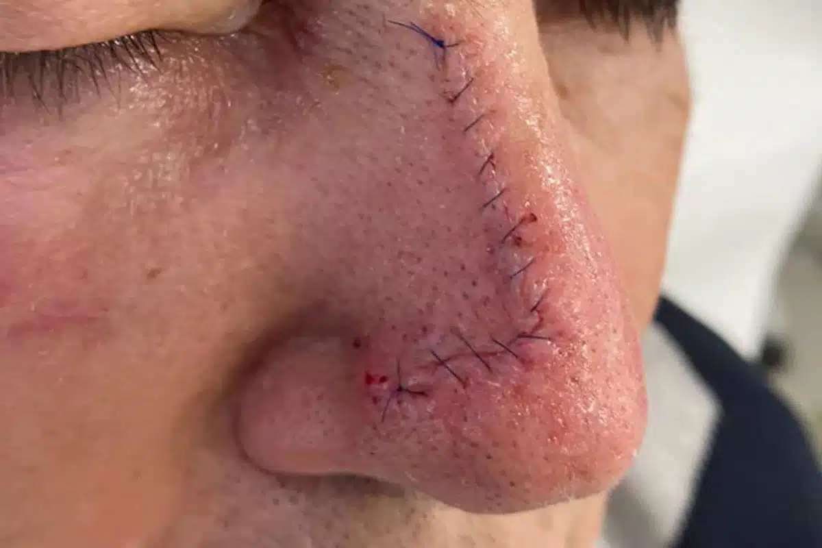 Dermatochirurgie: Basaliom Entfernung mit Verschiebe-Lappen-Plastik - JUVENIS in Wien