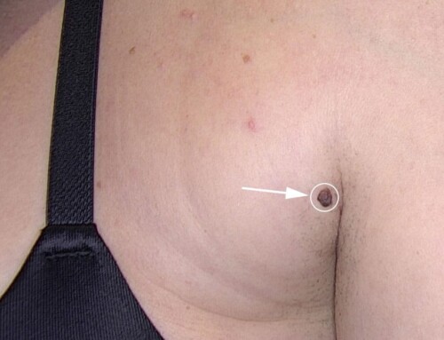 Muttermalentfernung mittels Shave-Abtragung bei JUVENIS