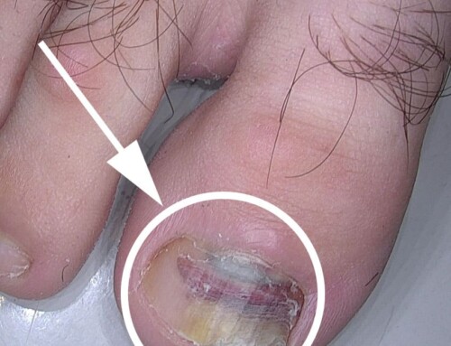 Effektive Behandlung von Nagelpilz bei Dr. Tamara Kopp im JUVENIS Medical Center in Wien