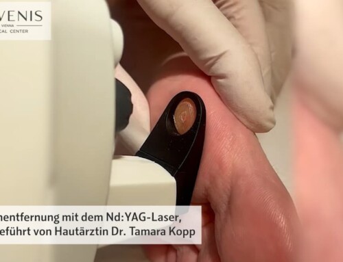 Effektive Warzenentfernung bei JUVENIS mit dem Nd:YAG-Laser