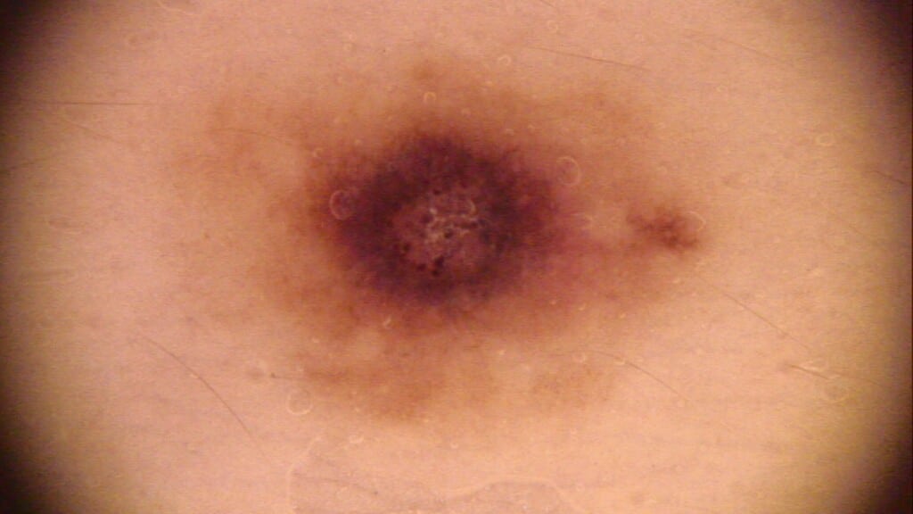 Marko eines Melanoms – JUVENIS in Wien Bei der Muttermalkontrolle: Melanom stark vergrößert - JUVENIS in Wien