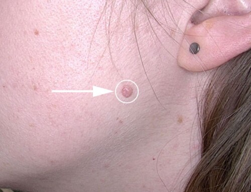 Muttermalentfernung im Gesicht – erfolgreich durchgeführt von Dr. Tamara Kopp