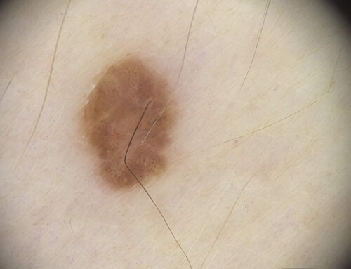 Früh erkannt, rechtzeitig behandelt: Melanom bei Muttermalkontrolle entdeckt