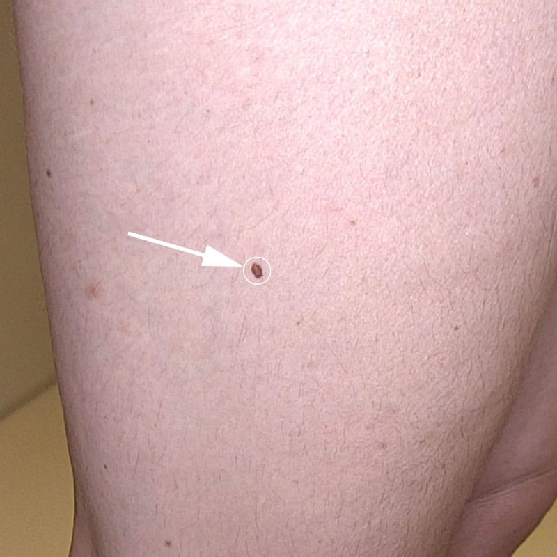 Bei Muttermalkontrolle ein Melanom entdeckt – Dr. Tamara Kopp – JUVENIS Wien