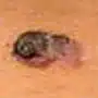 Melanom mit großem Durchmesser