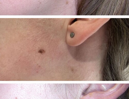 Muttermalentfernung mit ästhetischem Feingefühl bei JUVENIS