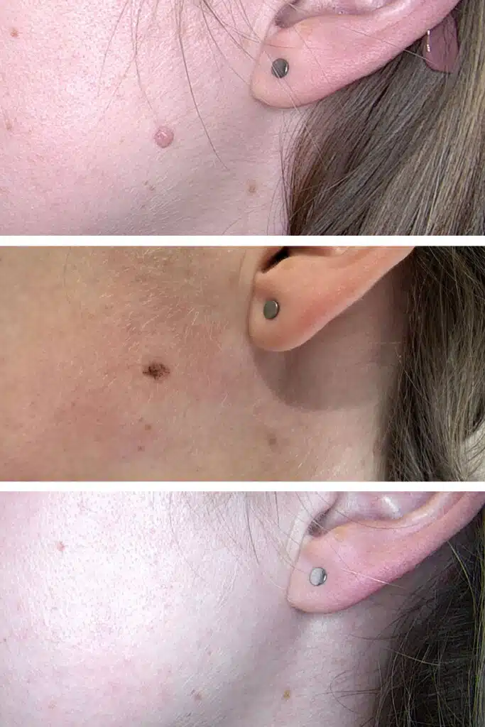 Muttermalentfernung bei JUVENIS in Wien durchgeführt von Dr. Tamara Kopp class="img-responsive