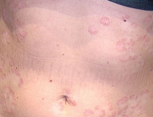 Erfolgreiche Psoriasis-Behandlung bei JUVENIS in Wien – Sichtbare Hautverbesserung dank individueller Therapie