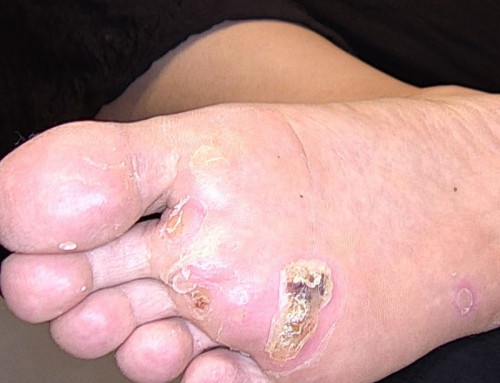 Hartnäckige Warzen erfolgreich entfernt – Nd:YAG-Laser zeigt Wirkung