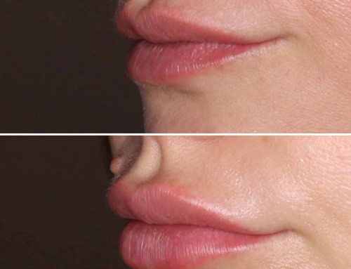 Natürlich volle Lippen durch Hyaluron – Vorher-Nachher-Ergebnis bei JUVENIS