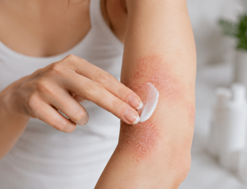 Treating atopic dermatitis: What helps with dry, irritated skin?